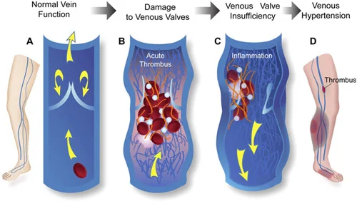 What is Venous Insufficiency?