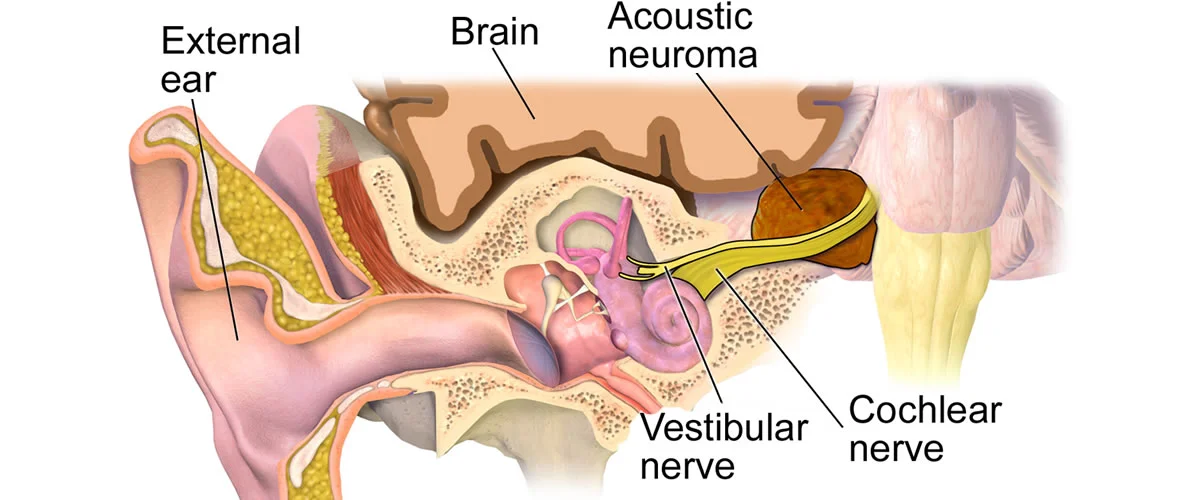 What is an Acoustic Neuroma?