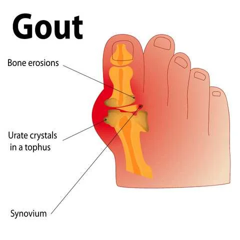 Got gout?  Eat like this