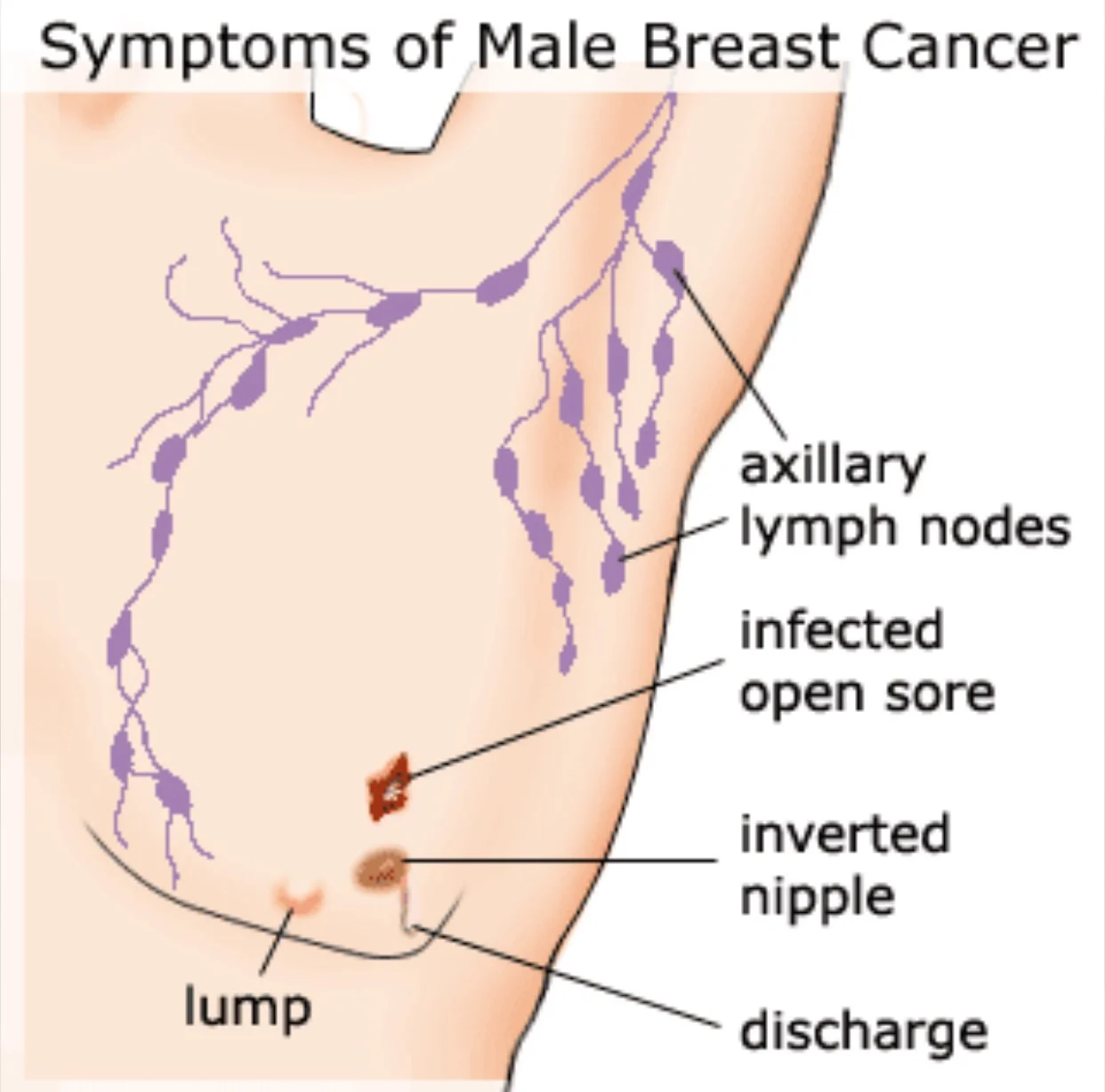 Male Breast Cancer