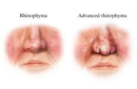 What Are The Symptoms Of Rhinophyma