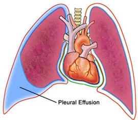 Understanding Pleural Effusion