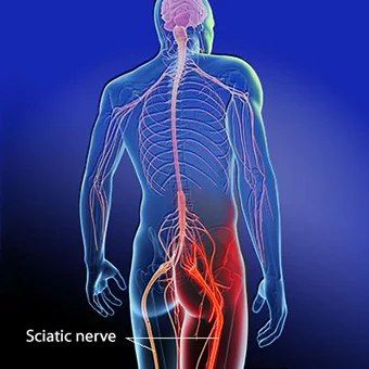 Sciatica and the Sciatic Nerve