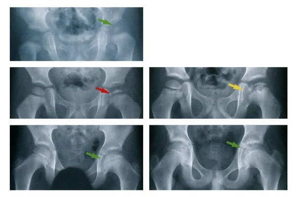 What is Legg-Calves-Perthes Disease?