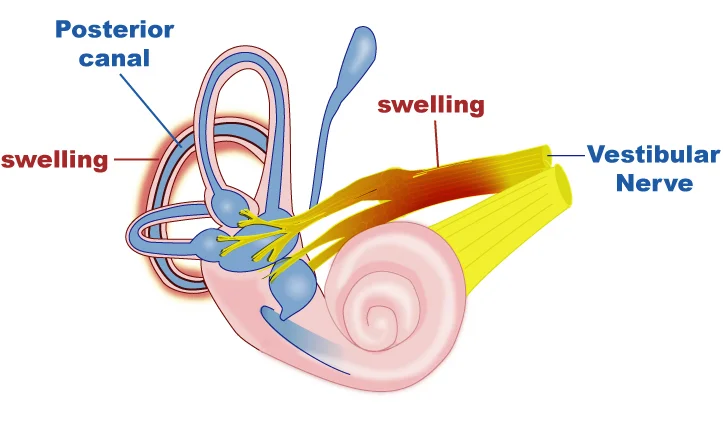 Risk Factors For Labyrinthitis