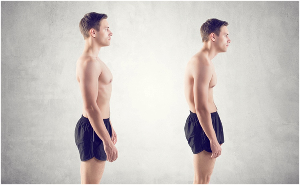 Symptoms of Kyphosis