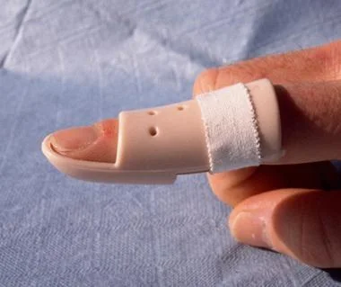 What is mallet finger?