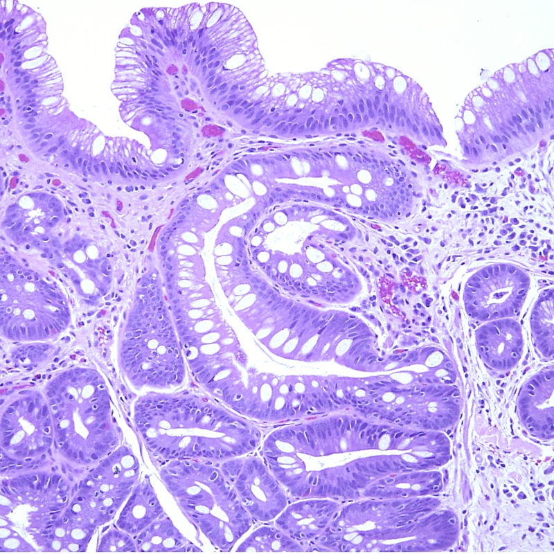 Grading Prostate Cancer