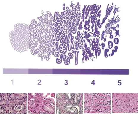 Staging of prostate cancer