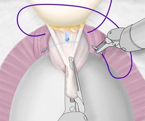 Prostate cancer: Cyberknife vs. Robotic surgery
