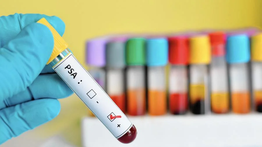 What is Percent-Free PSA?