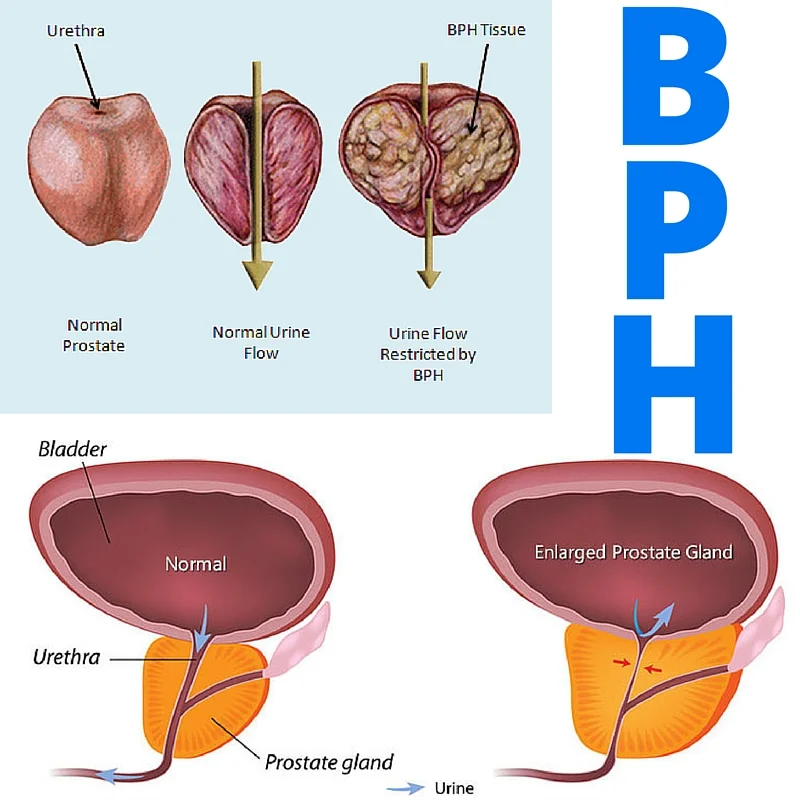 Treatment for BPH