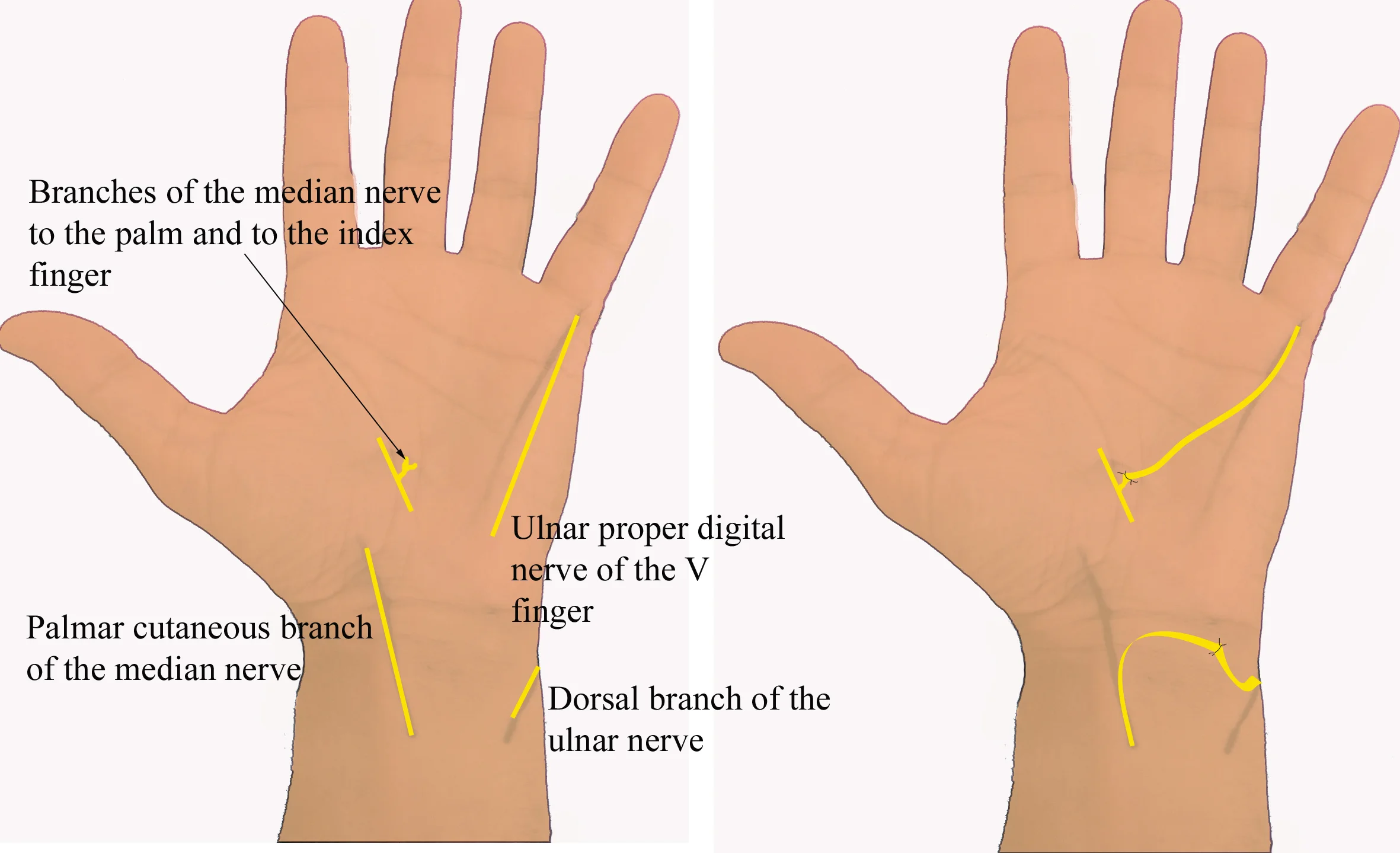 Learning About Median Nerve Injury