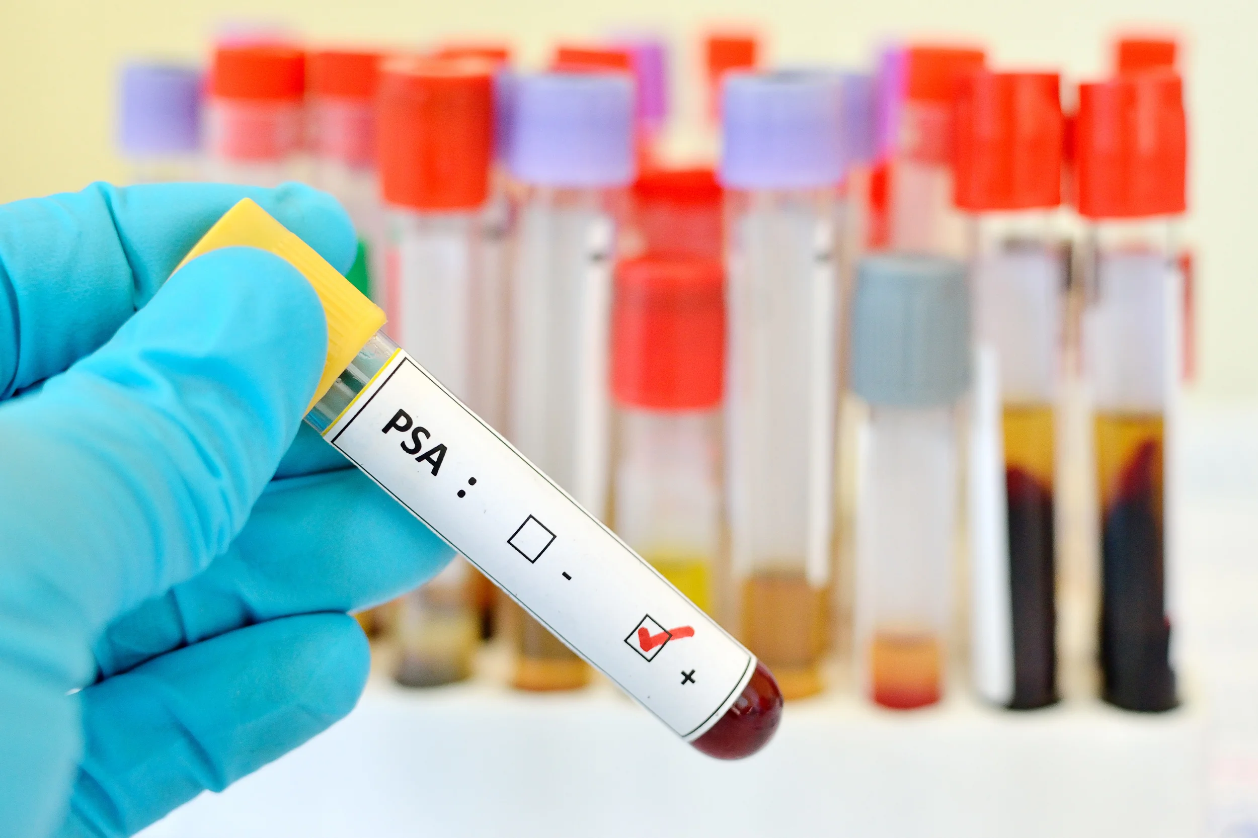 Treatment options for high PSA