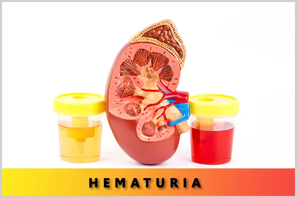 Causes for Hematuria