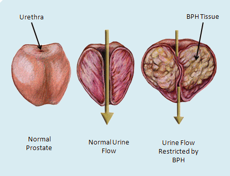 Signs and symptoms of benign prostatic hyperplasia