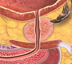 Seed implants for prostate cancer