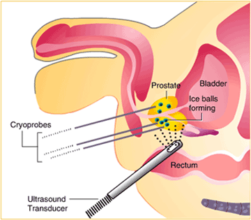 Cryosurgery for Prostate Cancer
