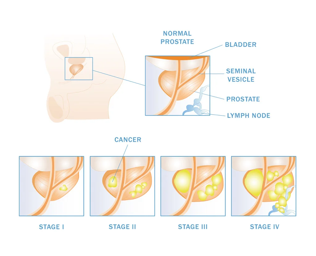 Staging system for prostate cancer