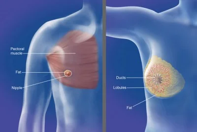 Rise in Men With Breast Cancer Opting For Double Mastectomies 