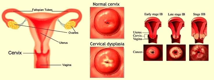 What is cervical dysplasia?