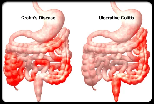 Crohn's Disease and the Right Diet