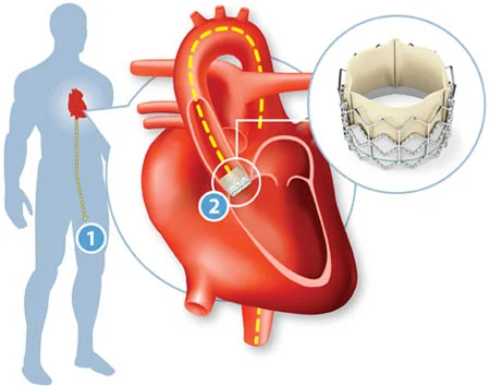 Transcatheter Aortic Valve Replacement