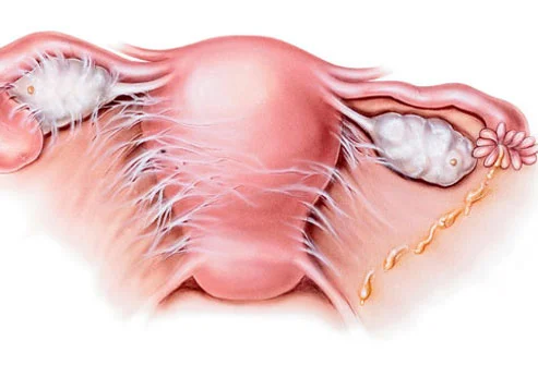 What women should know about pelvic inflammatory disease