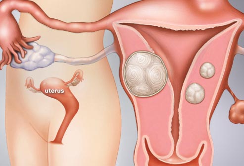 What is a hysterectomy?