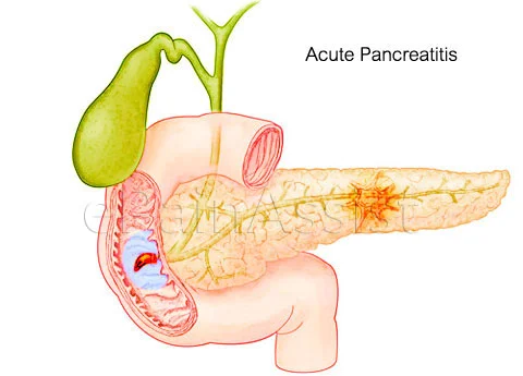 Do you have pancreatitis?