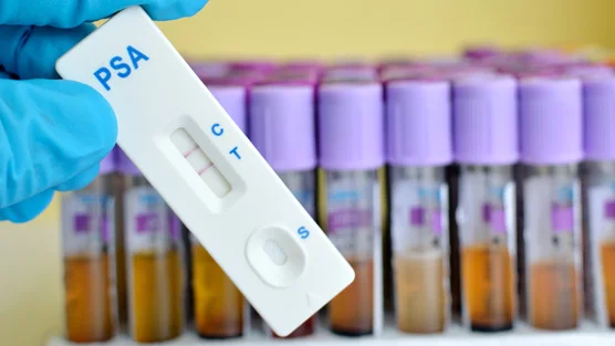 Low PSA levels linked to increased risk for cancer death