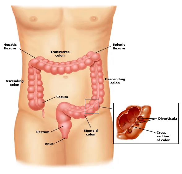 What is diverticulitis?