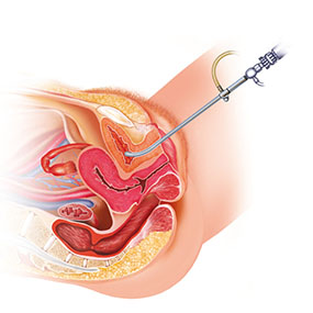 Interstitial Cystitis – How diet can improve symptoms