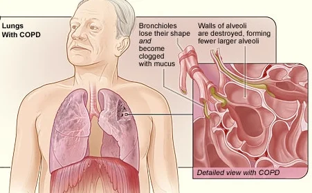 Chronic obstructive pulmonary disease 