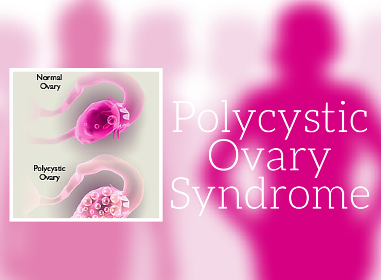 Facts on polycystic ovary syndrome and how diet and exercise can make a significant difference