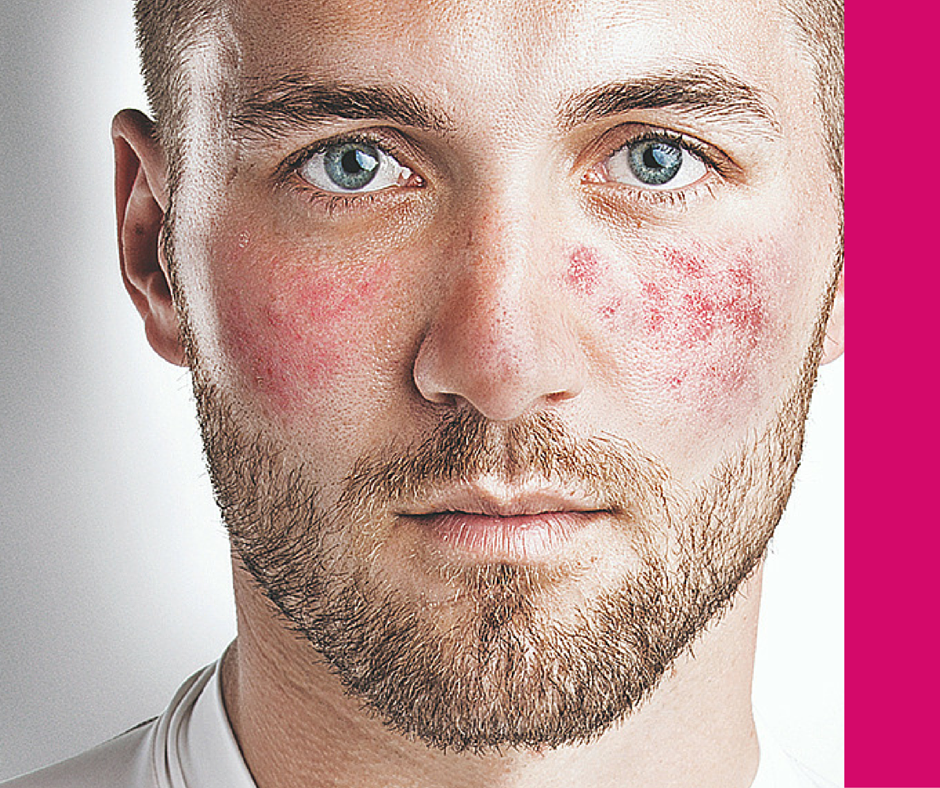 Effective Solutions for Rosacea