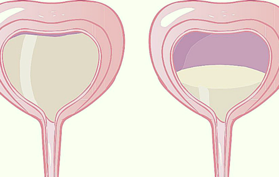 Tips to help with an overactive bladder