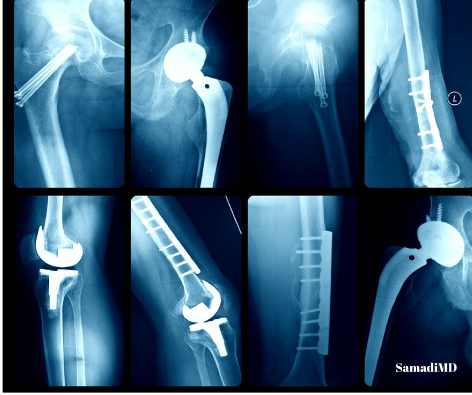 Things to Know About Hip Replacement Surgery