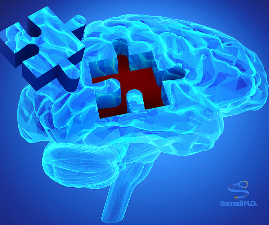 Recognizing Alzheimer's
