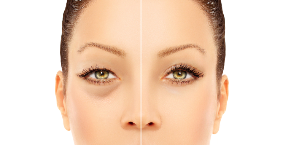 What is Blepharoplasty?