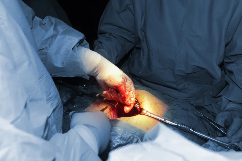 Stages of bladder cancer