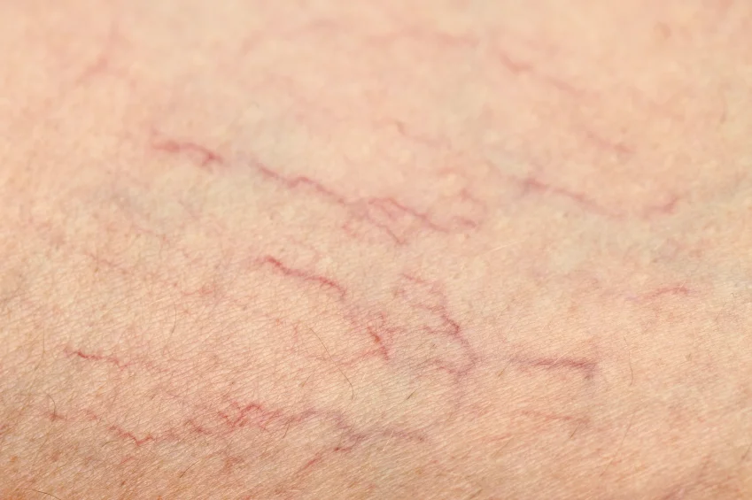 What are Varicose Veins