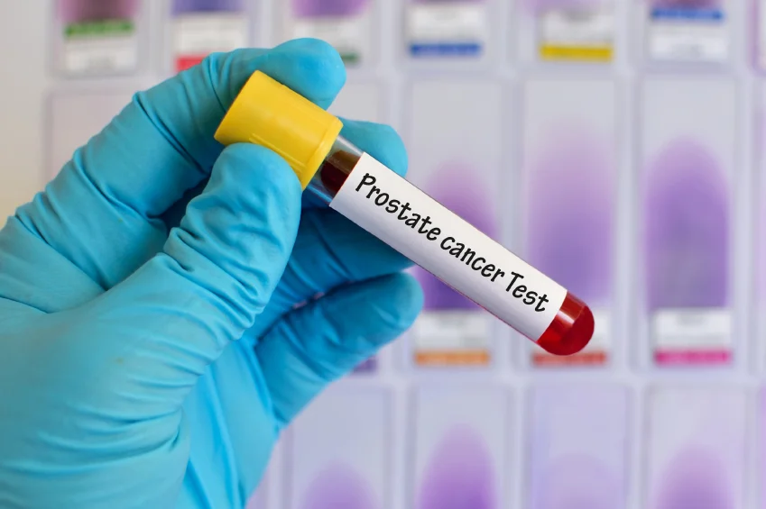 Prostate Health Index: New prostate cancer blood test