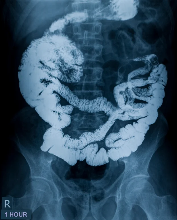 Next month is colorectal cancer awareness month