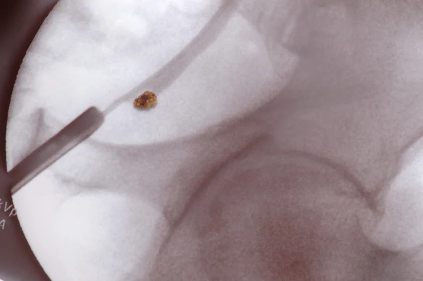 How to tell if you have bladder stones