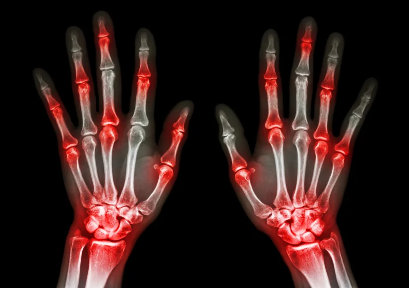 Is it possible to prevent arthritis?