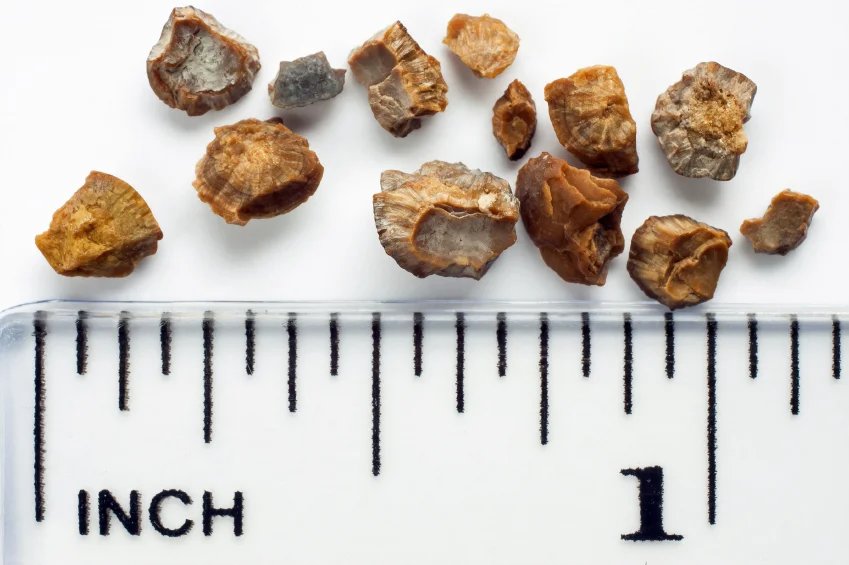Kidney Stones Are on the Rise, Is our Lifestyle to Blame?