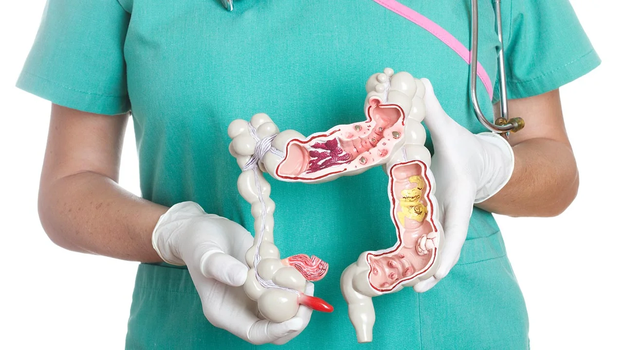 Preventative Tips for Colon Cancer