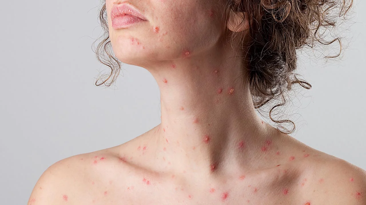 Can You Get Chicken Pox As An Adult?