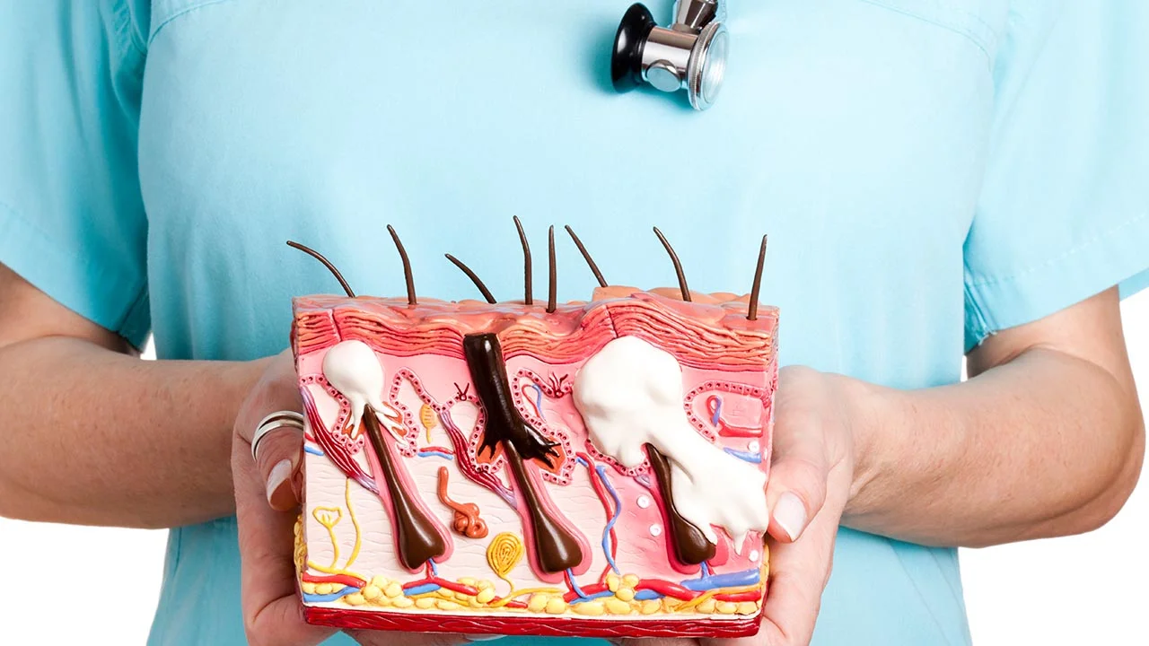 How to Treat a Skin Cyst